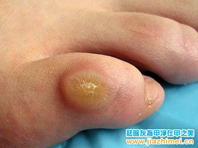 鸡眼,脚垫,瘊子有什么区别?是怎样形成的?