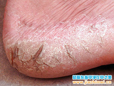 真菌感染足癣后冬季出现足跟皲裂